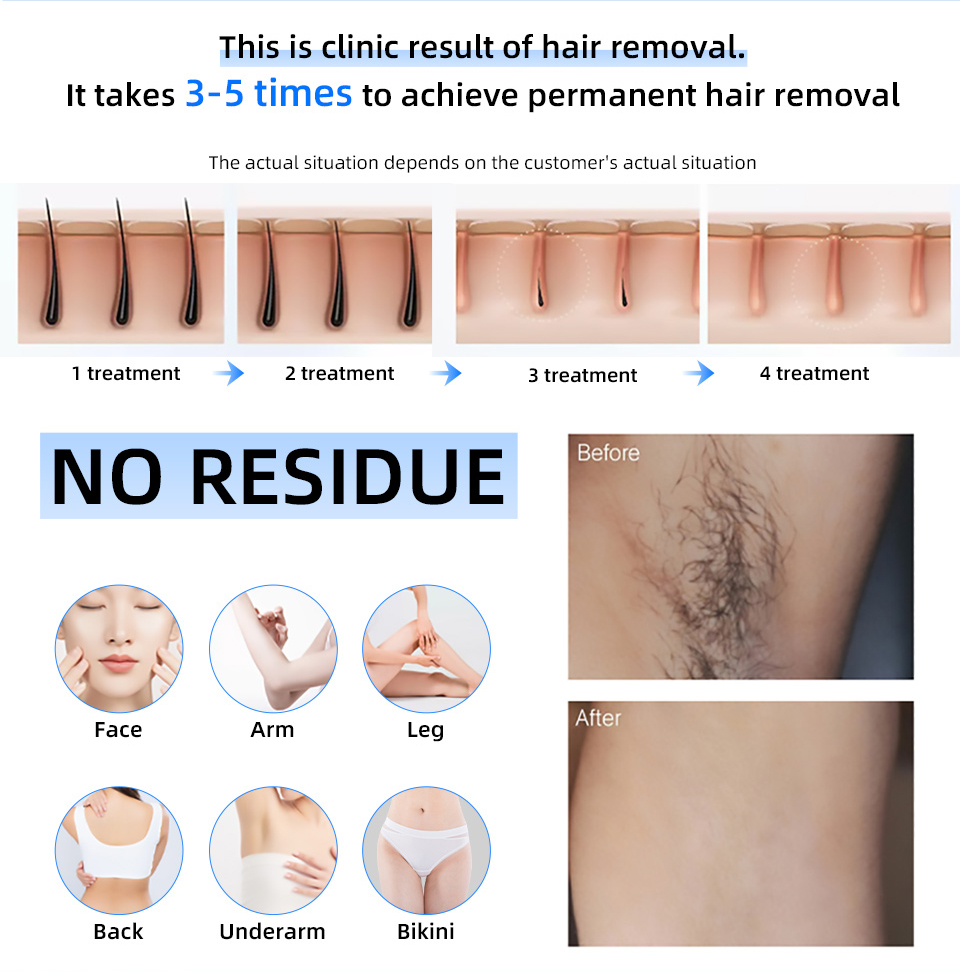 Factory Price 20000000 Beat 80 - Industrial Laser Hair Removal Machine review and price